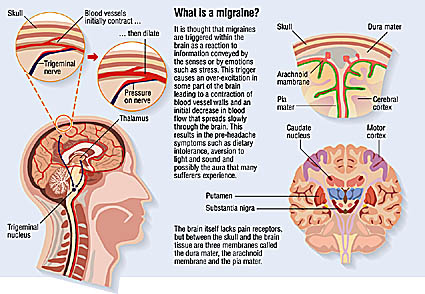 Migraine Medication  Pennsylvania Spine and Headache Center